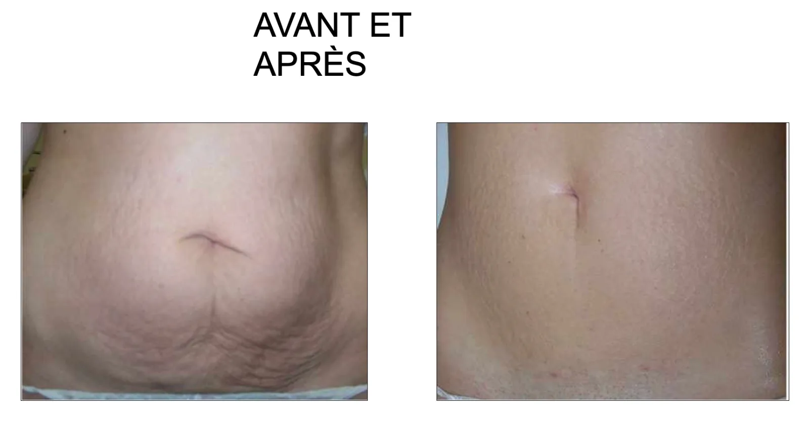 avant après hifu cifu èlife soin ventre retendre peau