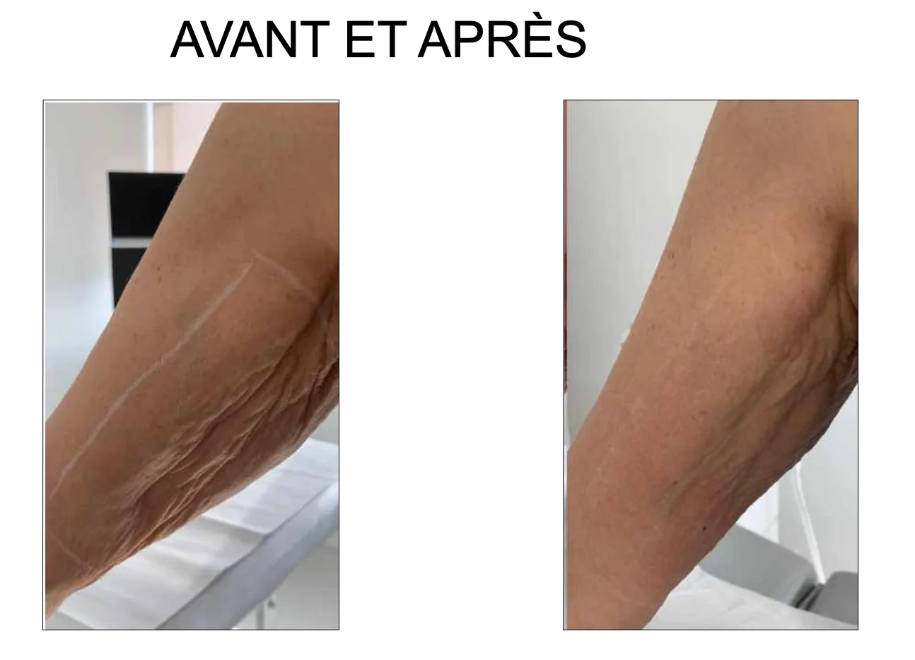 avant après hifu cifu èlife soin bras retendre peau
