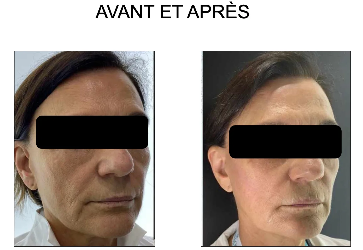 avant après hifu cifu èlife soin visage retendre peau
