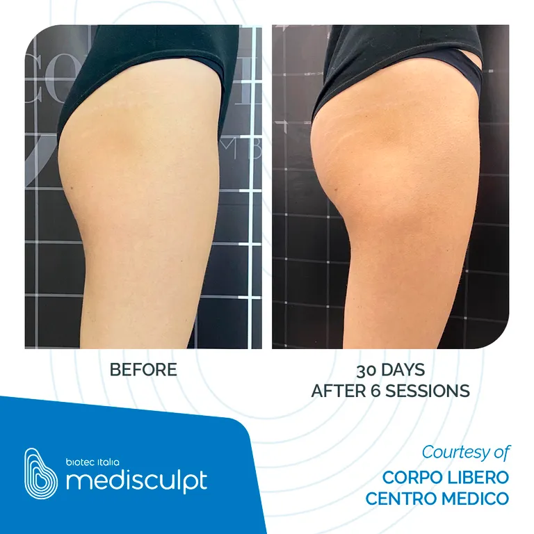 Medisculpt avant / après