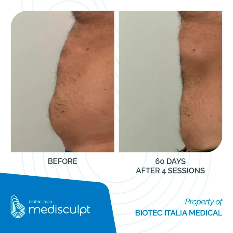 Medisculpt avant / après